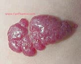 Infantile hemangioma during propranolol treatment
