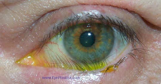 Clinical photograph of trichiasis with lashes contacting the ocular surface