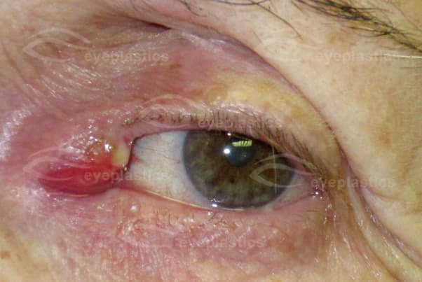 Canaliculitis of the upper canaliculus โ left upper eyelid