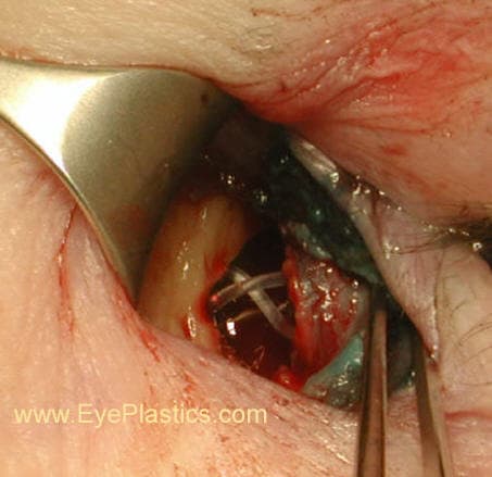 DCR surgery โ exposure of the lacrimal sac region