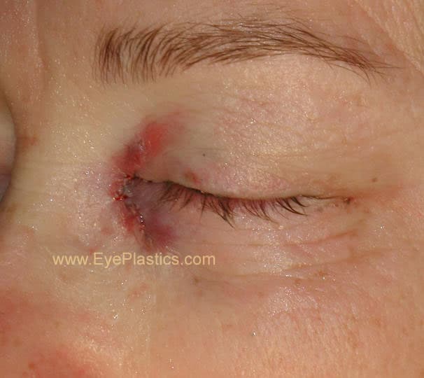 DCR surgery โ the opened lacrimal sac and new passage into the nose