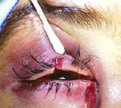 Canalicular laceration — medial eyelid laceration with canalicular involvement