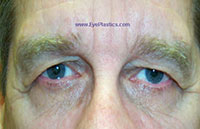 Pre-Operative photograph: Brow Ptosis, excess skin